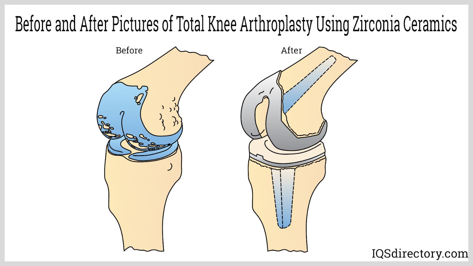 Before and After Pictures of Total Knee Arthroplasty Using Zirconia Ceramics