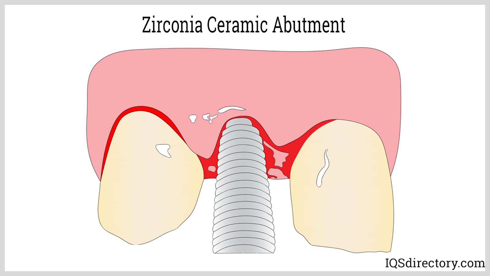 Zirconia Ceramic Abutment