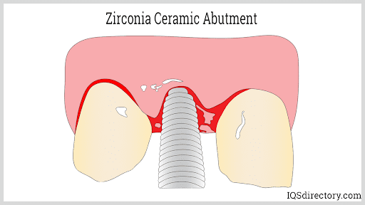 Zirconia Ceramic Abutment