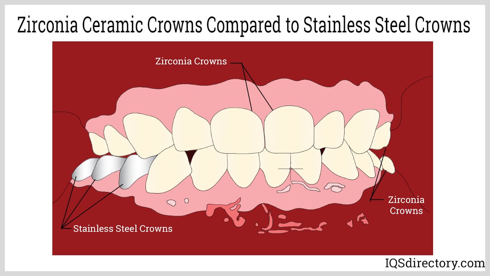 Zirconia Ceramic Crowns Compared to Stainless Steel Crowns