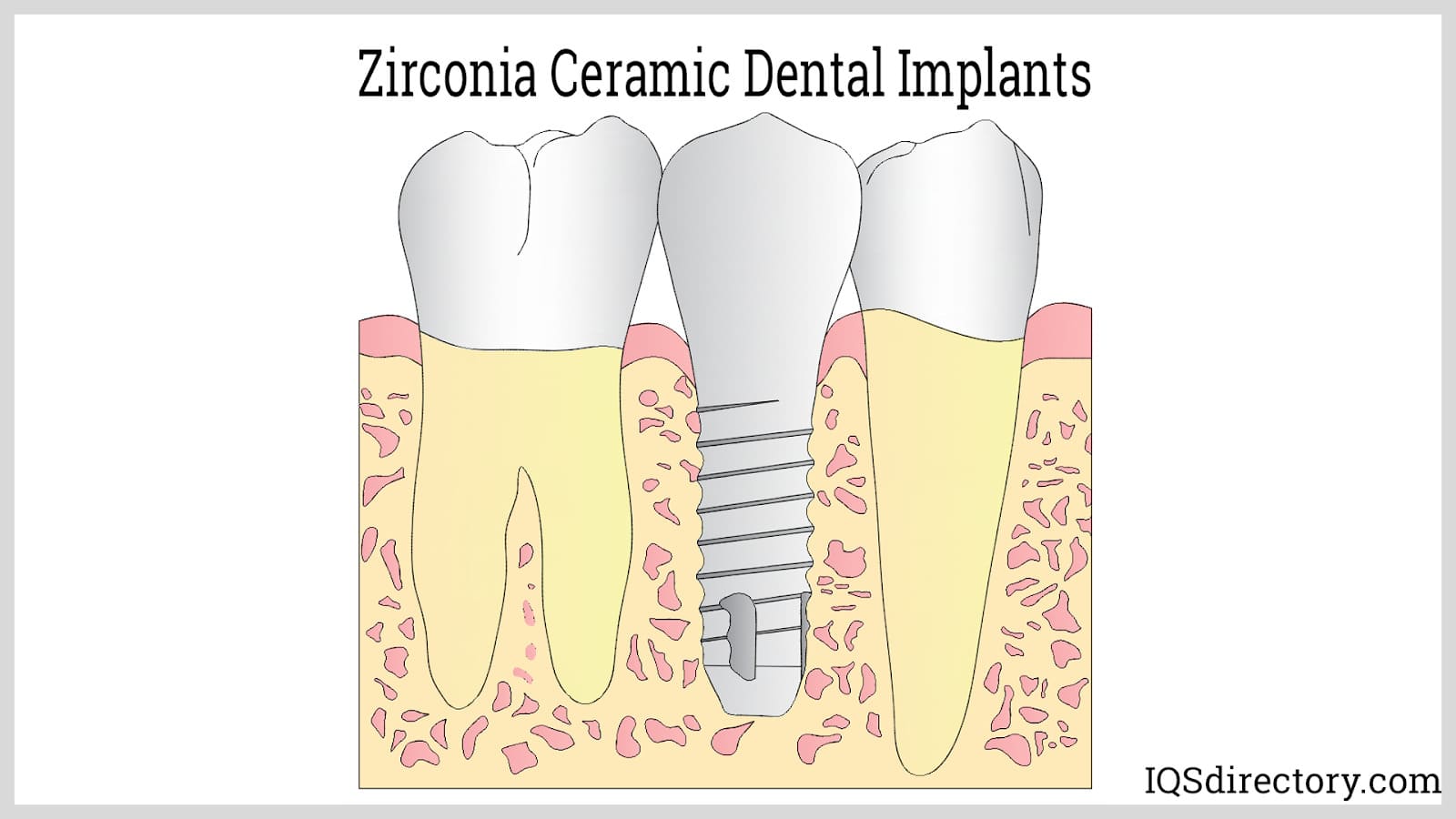 Zirconia Ceramic Dental Implants